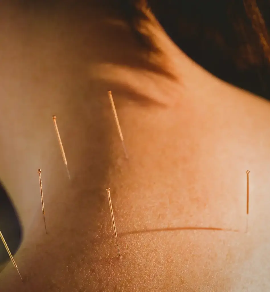 Das Bild zeigt einen Rückennahaufnahme mit Akupunkturnadeln. Das Bild wird im Bereich "Akupunktur" verwendet.