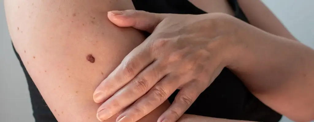 Das Bild zeigt einen Arm einer Frau mit einem auffälligen Leberfleck. Die Frau hält ihre Hand an den Arm. Das Bild wird im Bereich "Hautcheck" verwende.