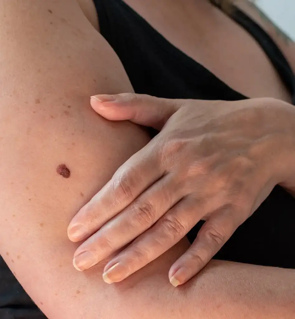 Das Bild zeigt einen Arm einer Frau mit einem auffälligen Leberfleck. Die Frau hält ihre Hand an den Arm. Das Bild wird im Bereich "Hautcheck" verwende.