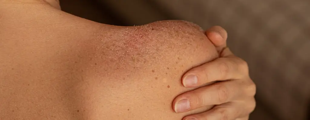 Das Bild zeigt eine weibliche Schulter mit Pigmentpflecken und Hautirritationen. Mit der Hand hält sich die Person die Schulter. Das Bild wird im Bereich "Photodynamische-lichttherapie" verwendet.